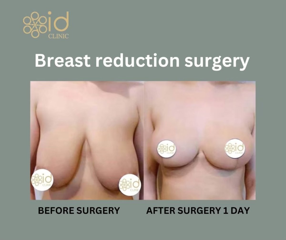 Before and after breast reduction surgery results at ID Clinic Bangkok, visible size reduction