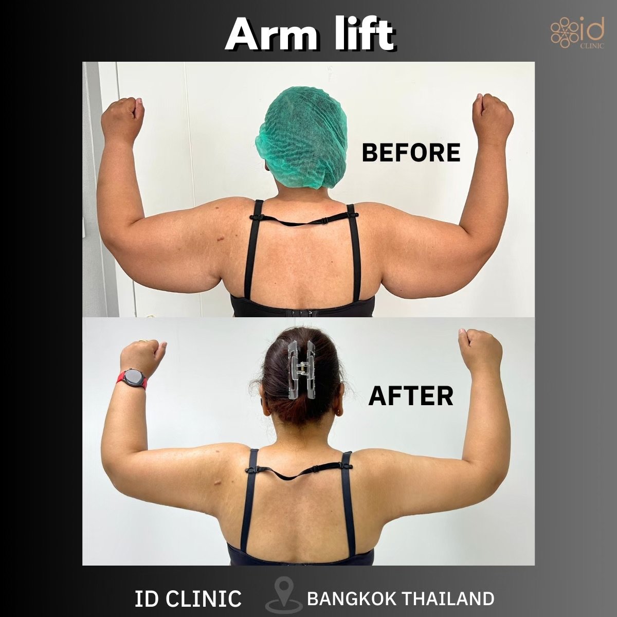 Before and after arm lift results at ID Clinic Bangkok, visible arm contour improvement