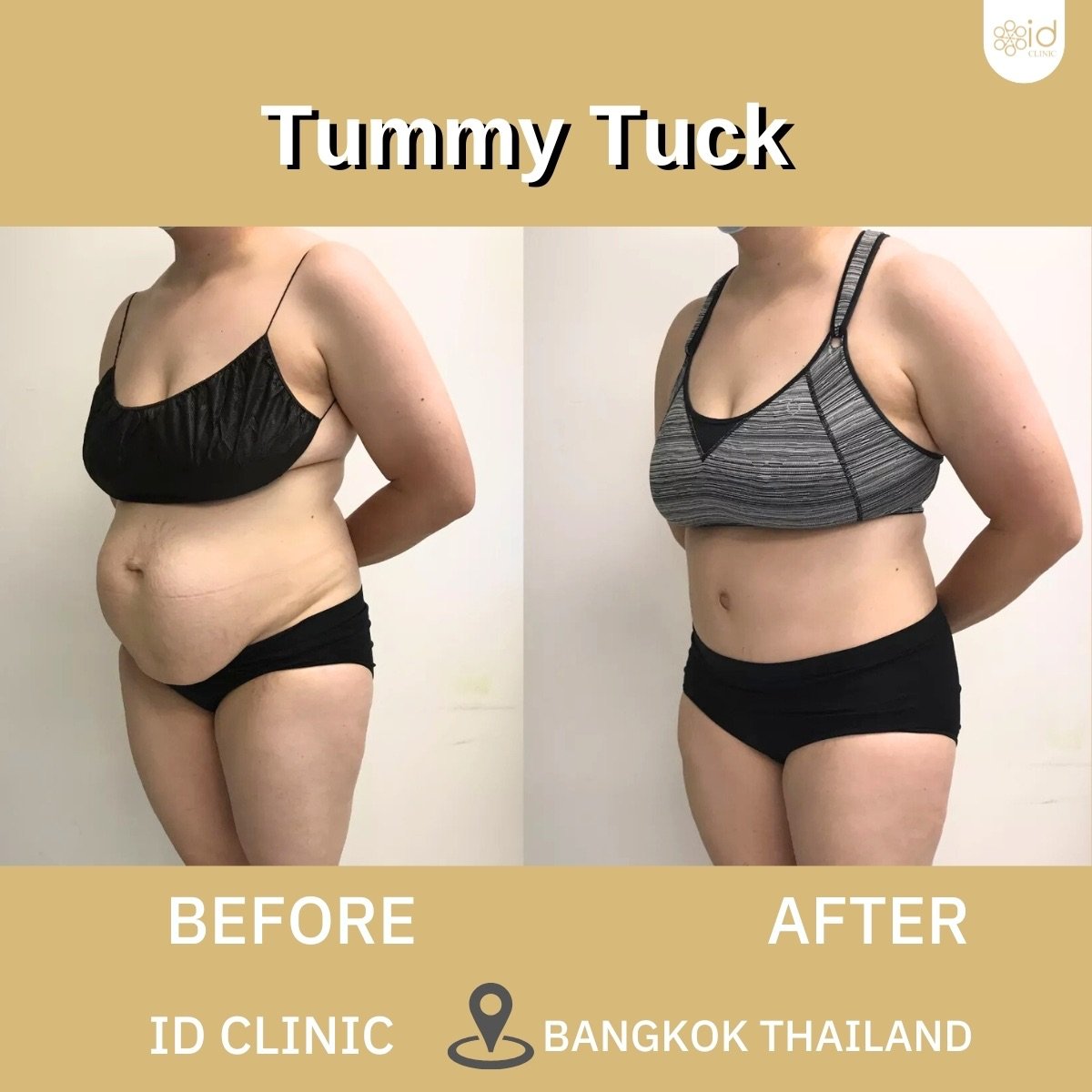 Before and after tummy tuck results at ID Clinic Bangkok – visible abdominal contour improvement