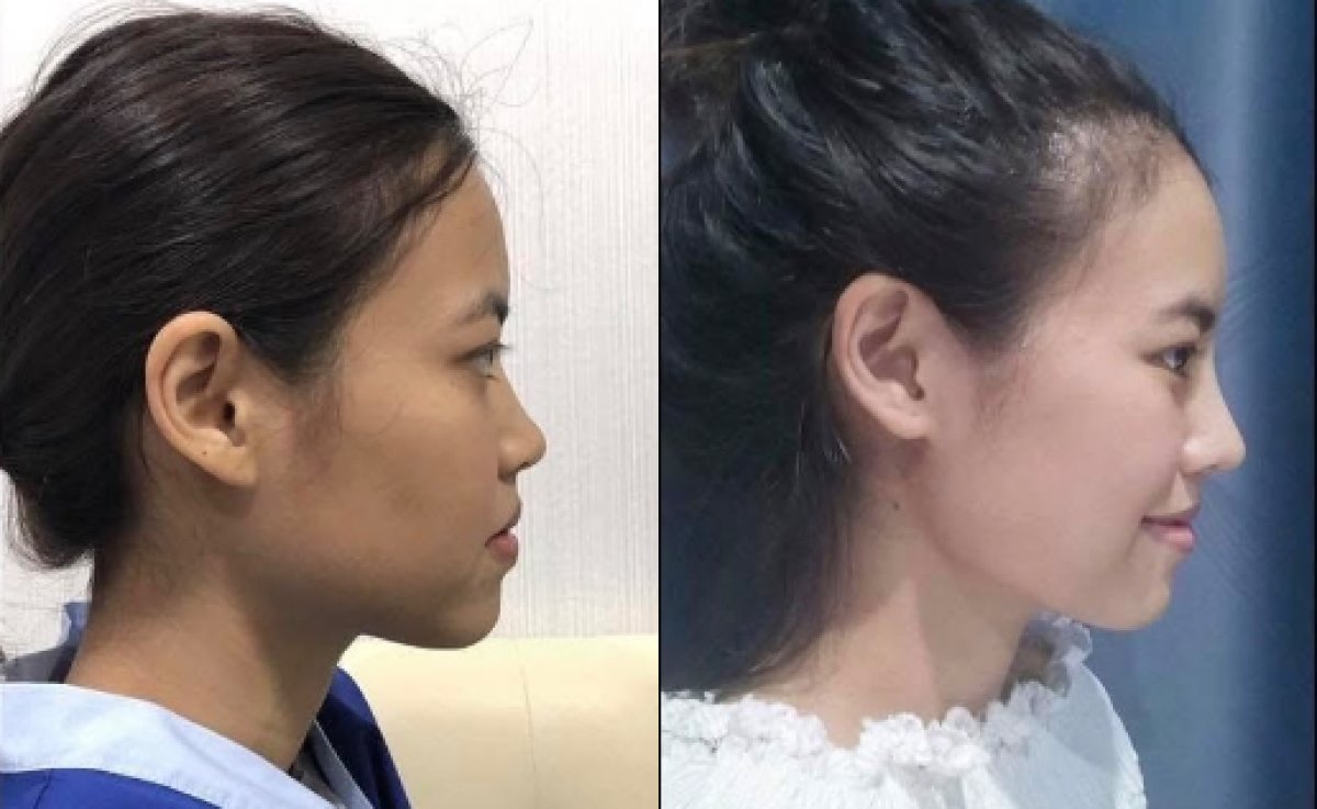 Before and after rhinoplasty results, nose reshaping with improved profile and natural look