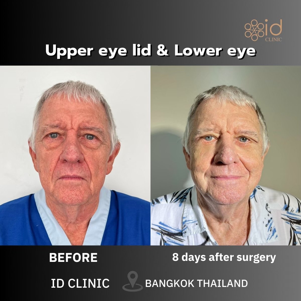 Before and after blepharoplasty results at ID Clinic Bangkok, upper and lower eyelid surgery