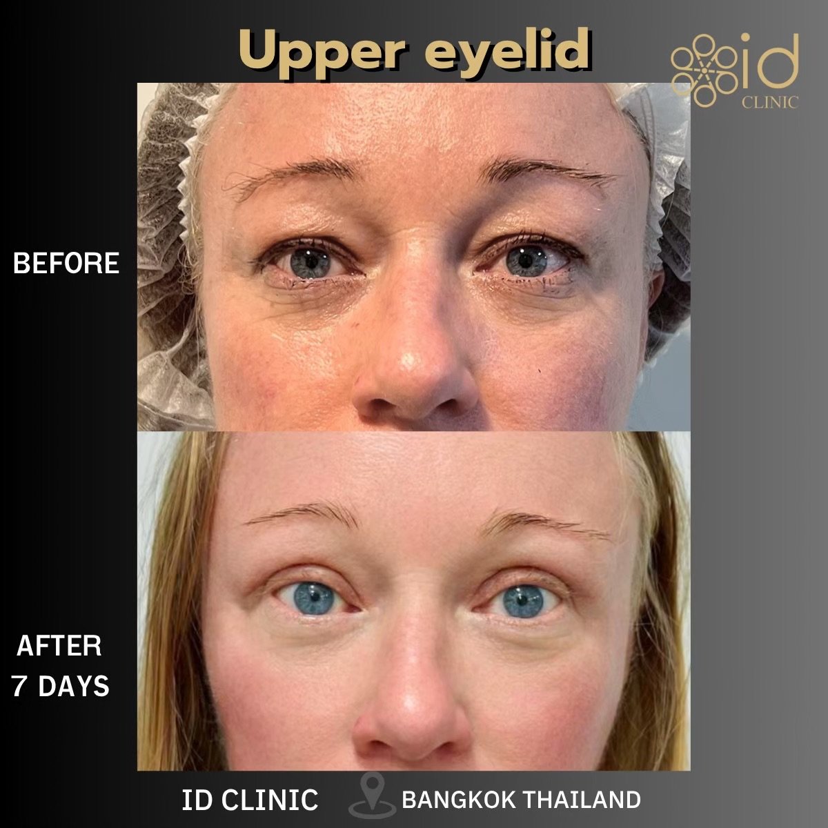Before and after upper eyelid blepharoplasty results at ID Clinic Bangkok after 7 days