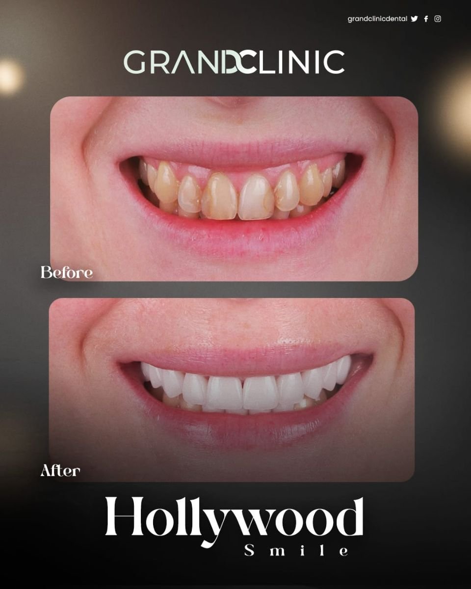 Результаты до и после установки циркониевого моста в Grand Clinic для улыбки Hollywood