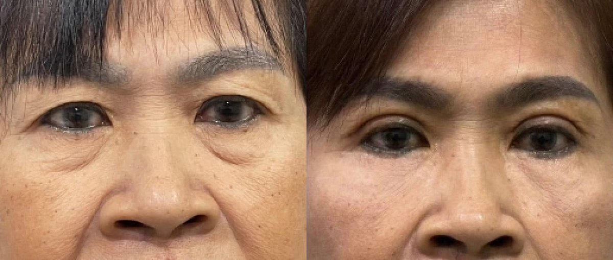 Résultats avant/après chirurgie des paupières supérieures et inférieures – peau lissée