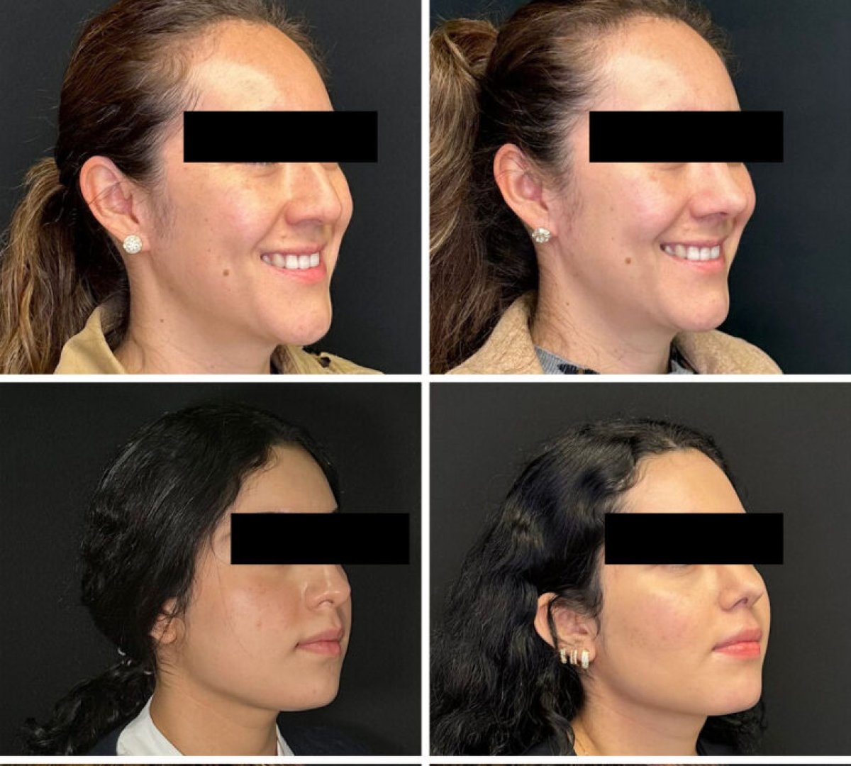 Before and after rhinoplasty results, nose reshaping with natural profile improvement