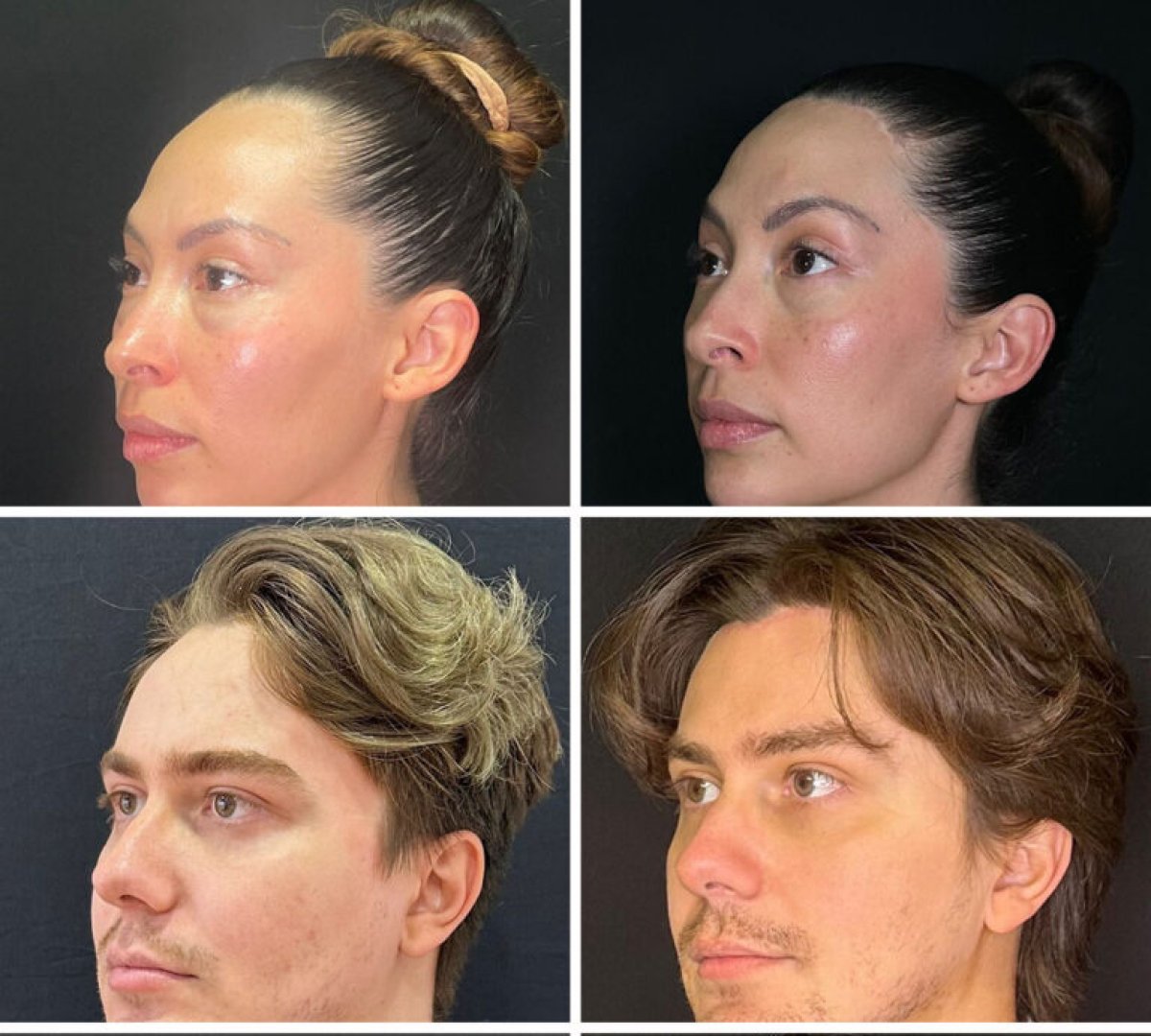 Resultados de rinoplastia antes y después, remodelación nasal para hombres y mujeres en la clínica