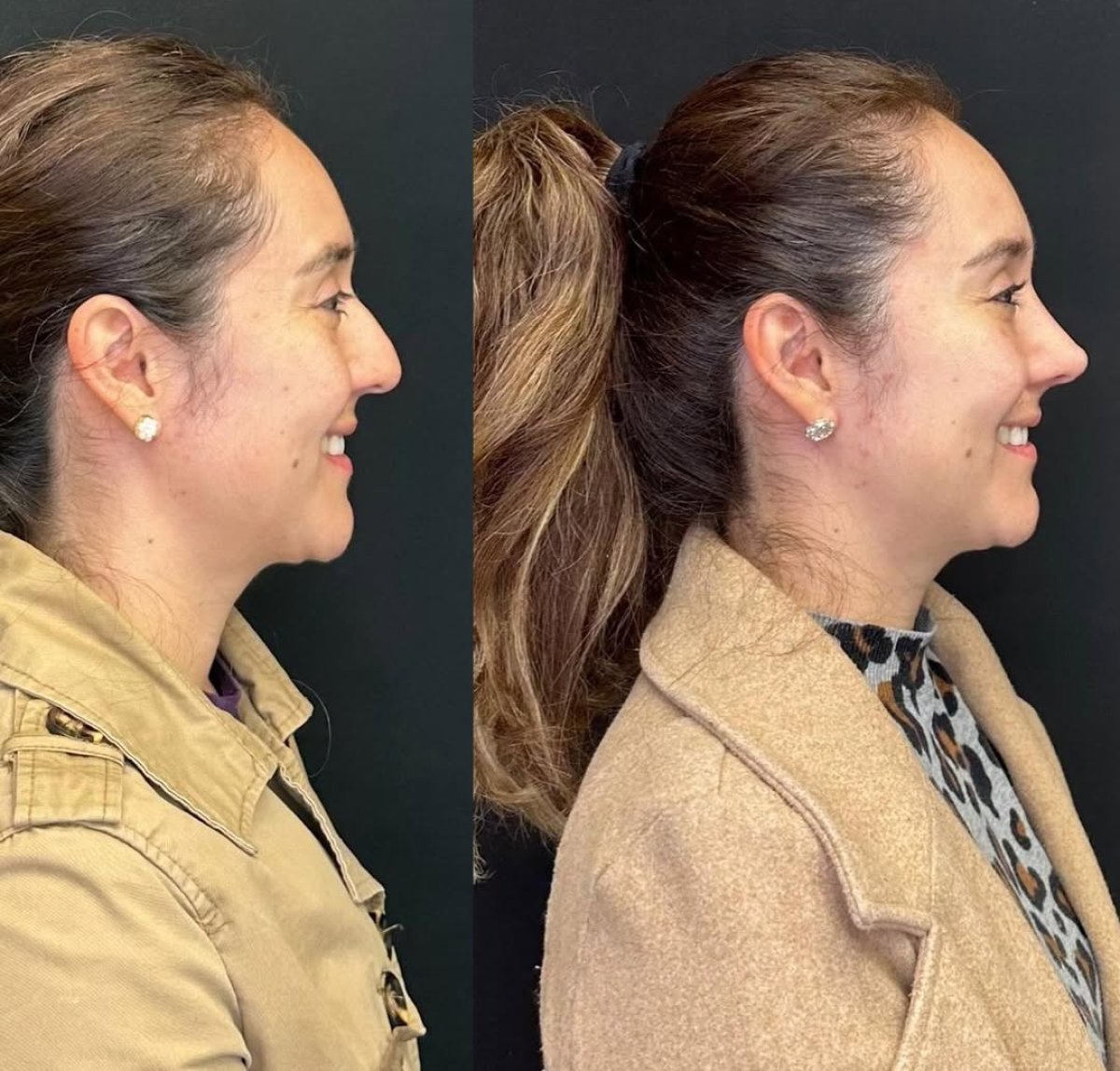 Before and after rhinoplasty results, improved nose profile and facial harmony