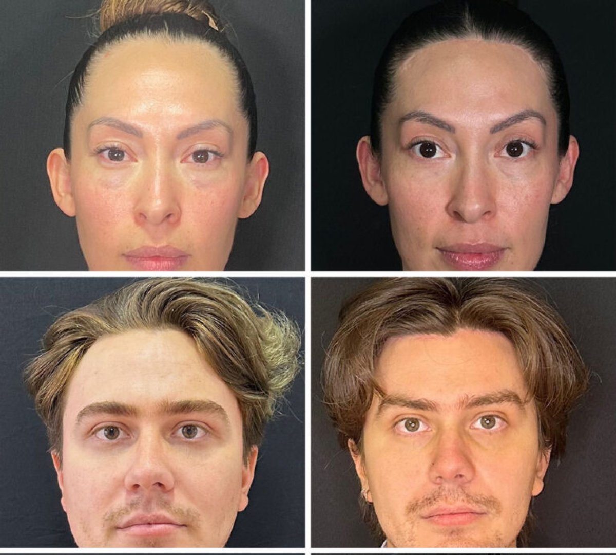 Before and after brow lift results – visible eyebrow elevation and refreshed appearance