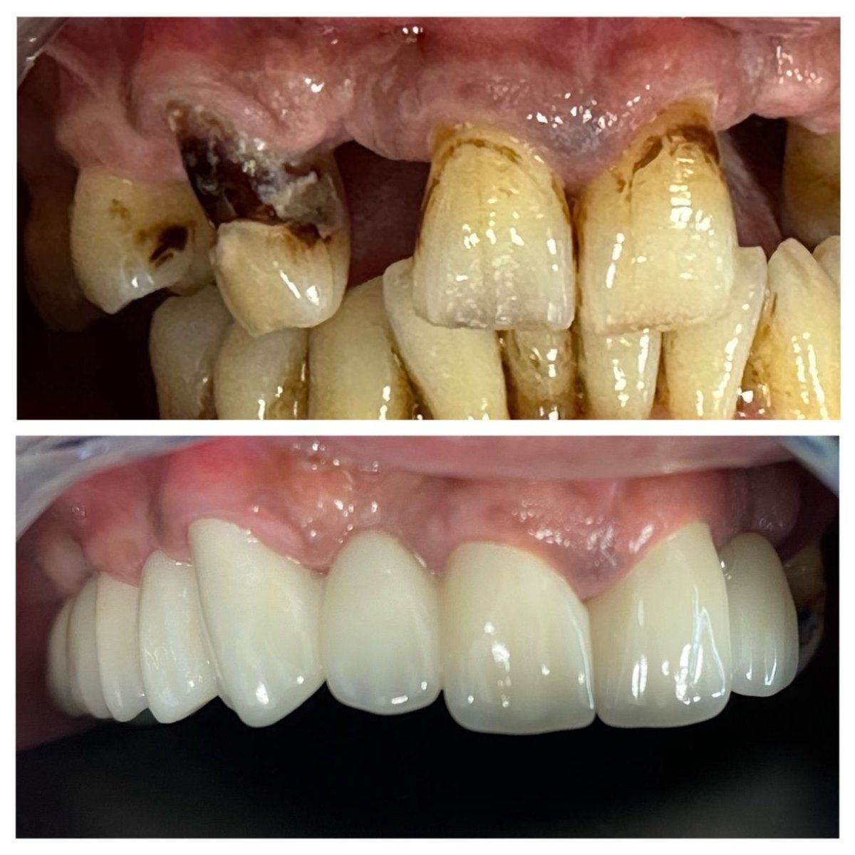 Before and after dental implant results at Ader Dent Oral and Dental Health Clinic, restored smile