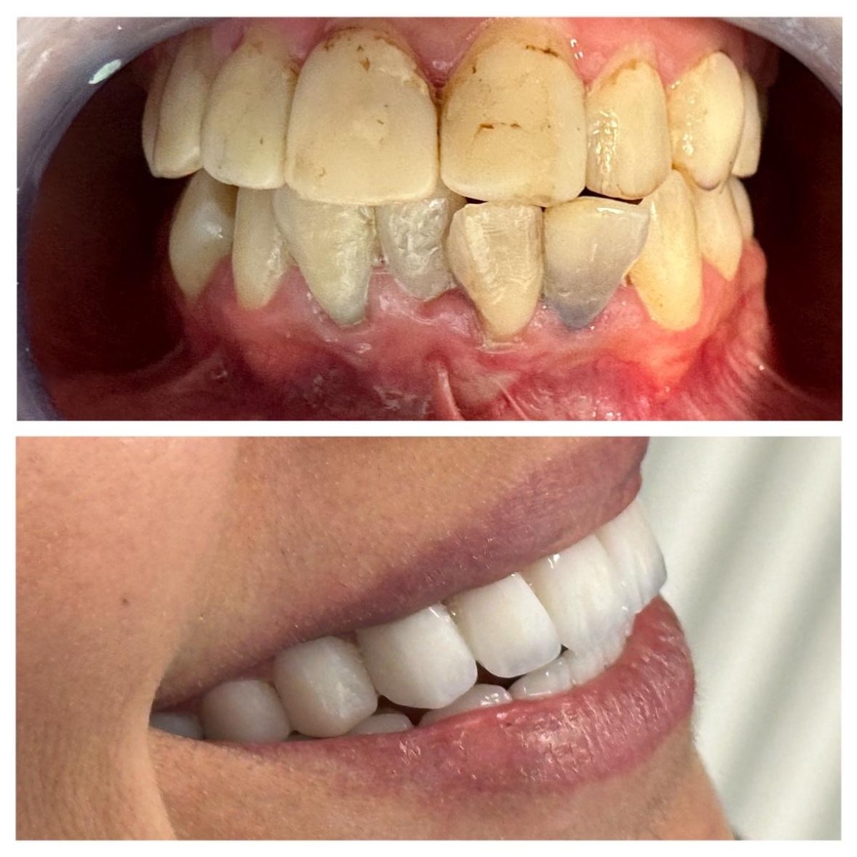 نتيجة قبل وبعد عدسات الأسنان في عيادة Ader Dent Oral and Dental Health Clinic، تجميل الابتسامة