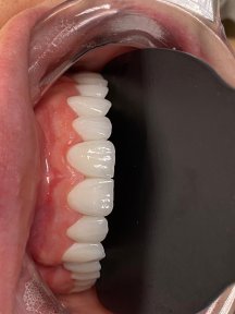 All-on-6 Dental Implants with Straumann - photo 5