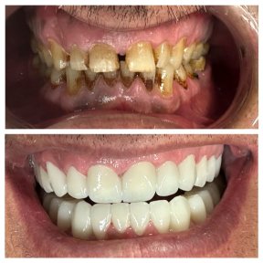 All-on-6 Dental Implants with Straumann - photo 4
