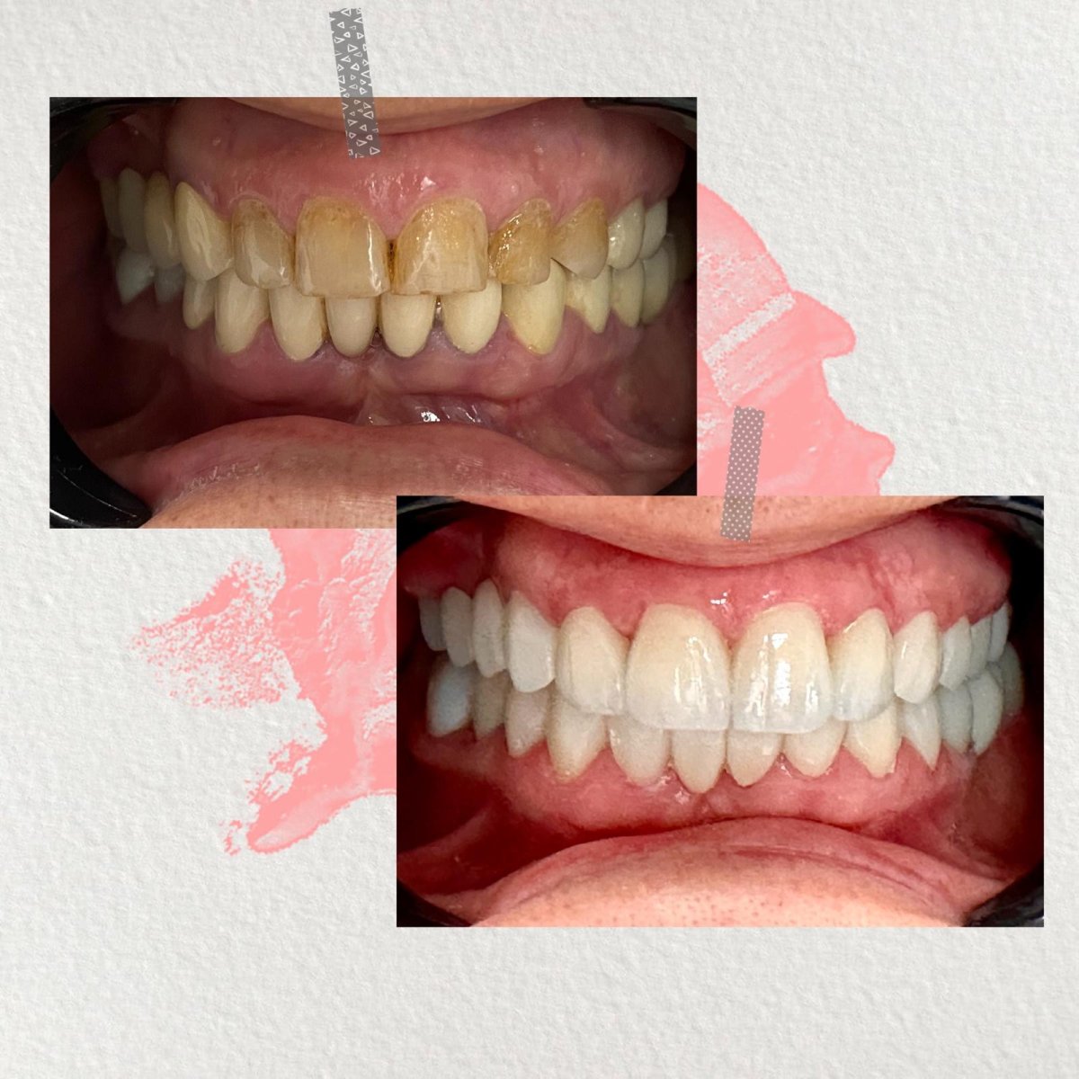 Vorher-nachher-Ergebnis Hollywood Smile bei Ader Dent Oral and Dental Health Clinic, weiße Zähne