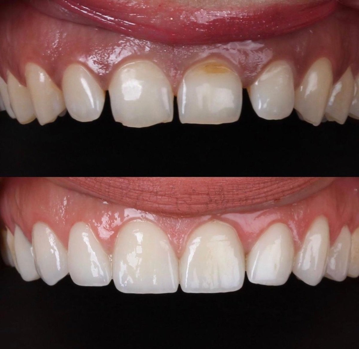 Before and after zirconia crown results at Ader Dent Oral and Dental Health Clinic, smile makeover