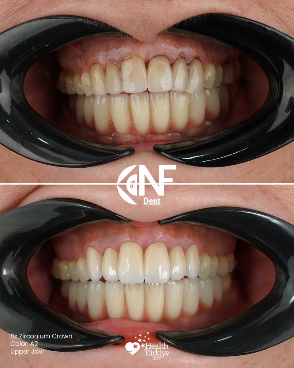 Before and after zirconium crowns at Nifa Dent International – upper jaw smile transformation result