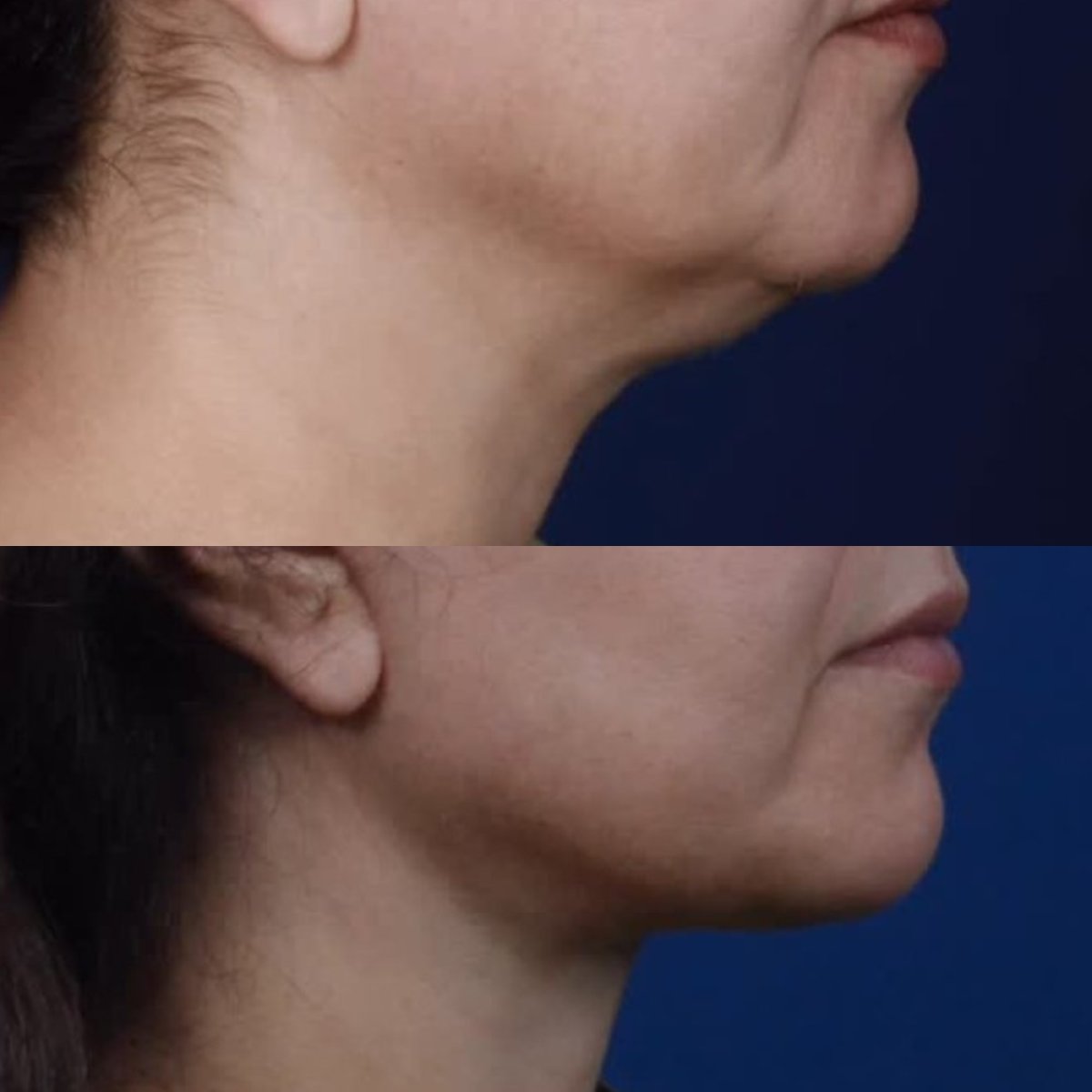 Resultados de lifting de cuello antes y después en National Prime Hospital, contorno mejorado