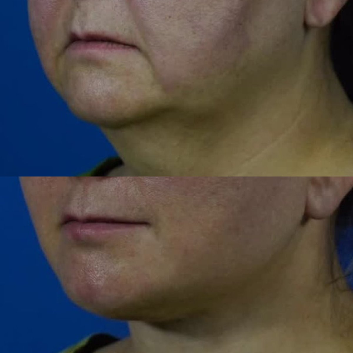 Before and after neck lift results at National Prime Hospital, improved jawline contour