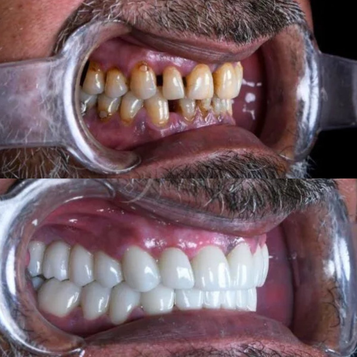Before and after dental crown installation results at Adalya Dental Clinic, improved smile