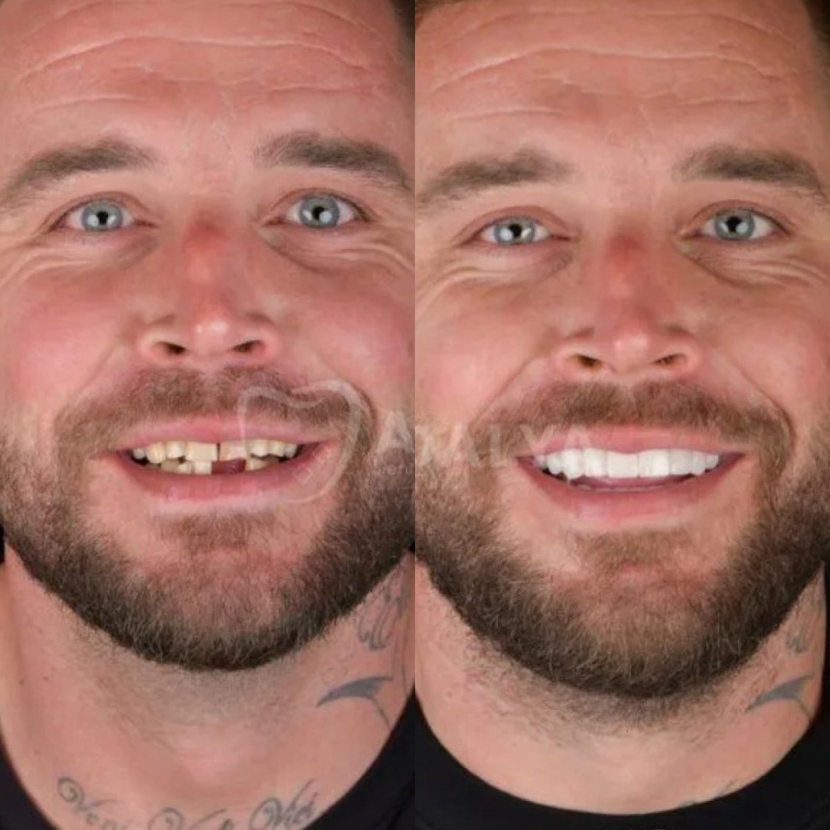 Before and after dental crown installation results at Adalya Dental Clinic, improved smile