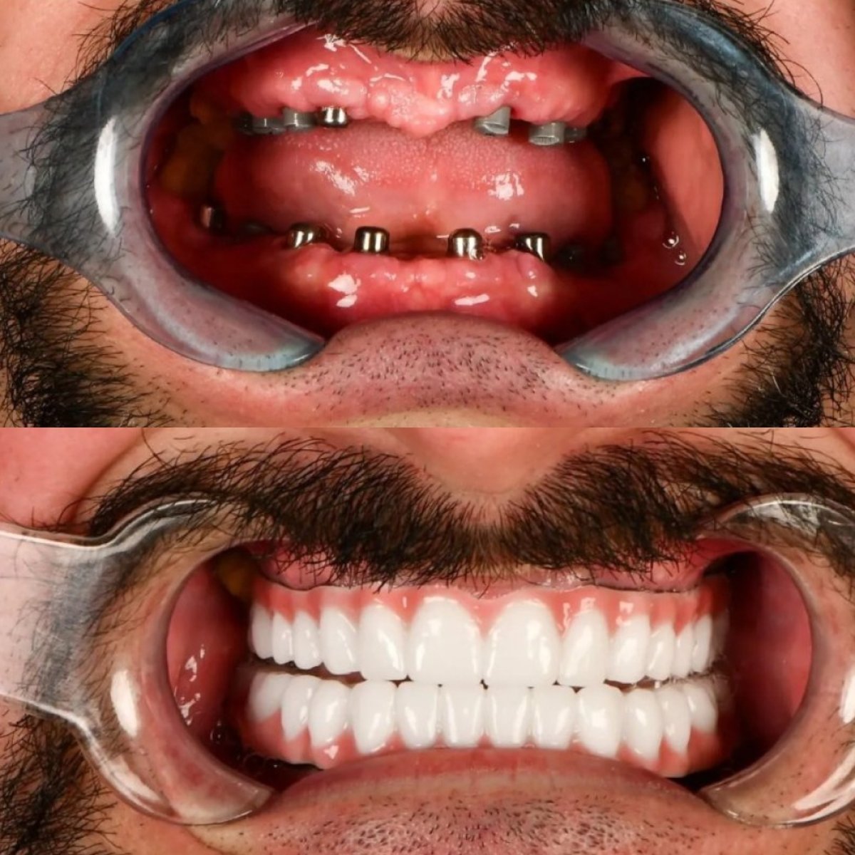 Before and after results of full-arch zirconia implant dentures at Adalya Dental Clinic