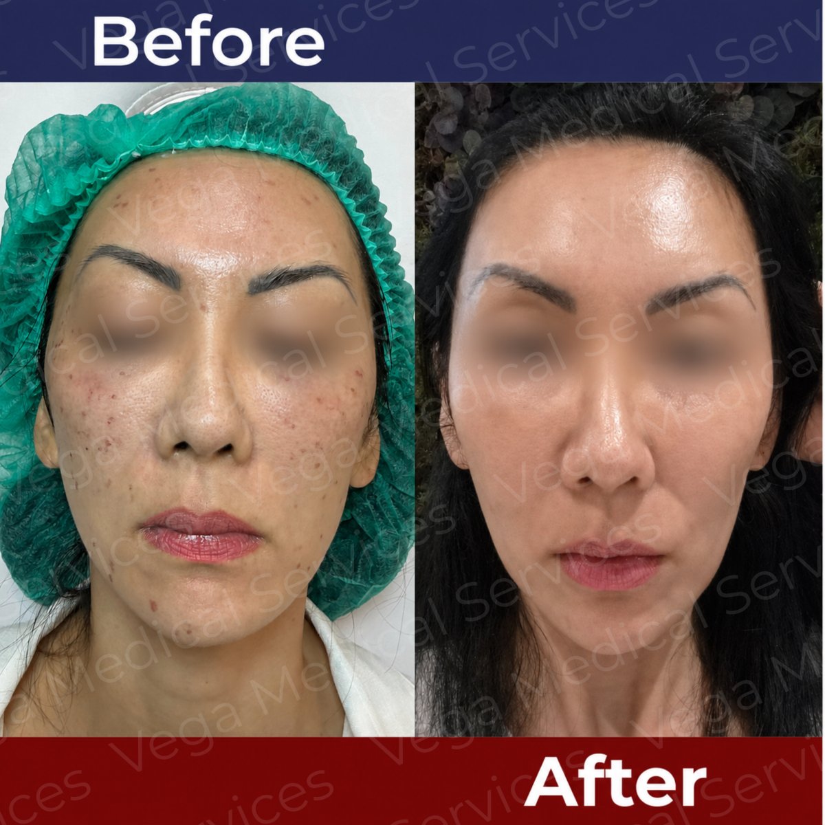 قبل وبعد علاج تجديد الشباب بالخلايا الجذعية في Vega Clinic – نتائج مكافحة الشيخوخة واضحة