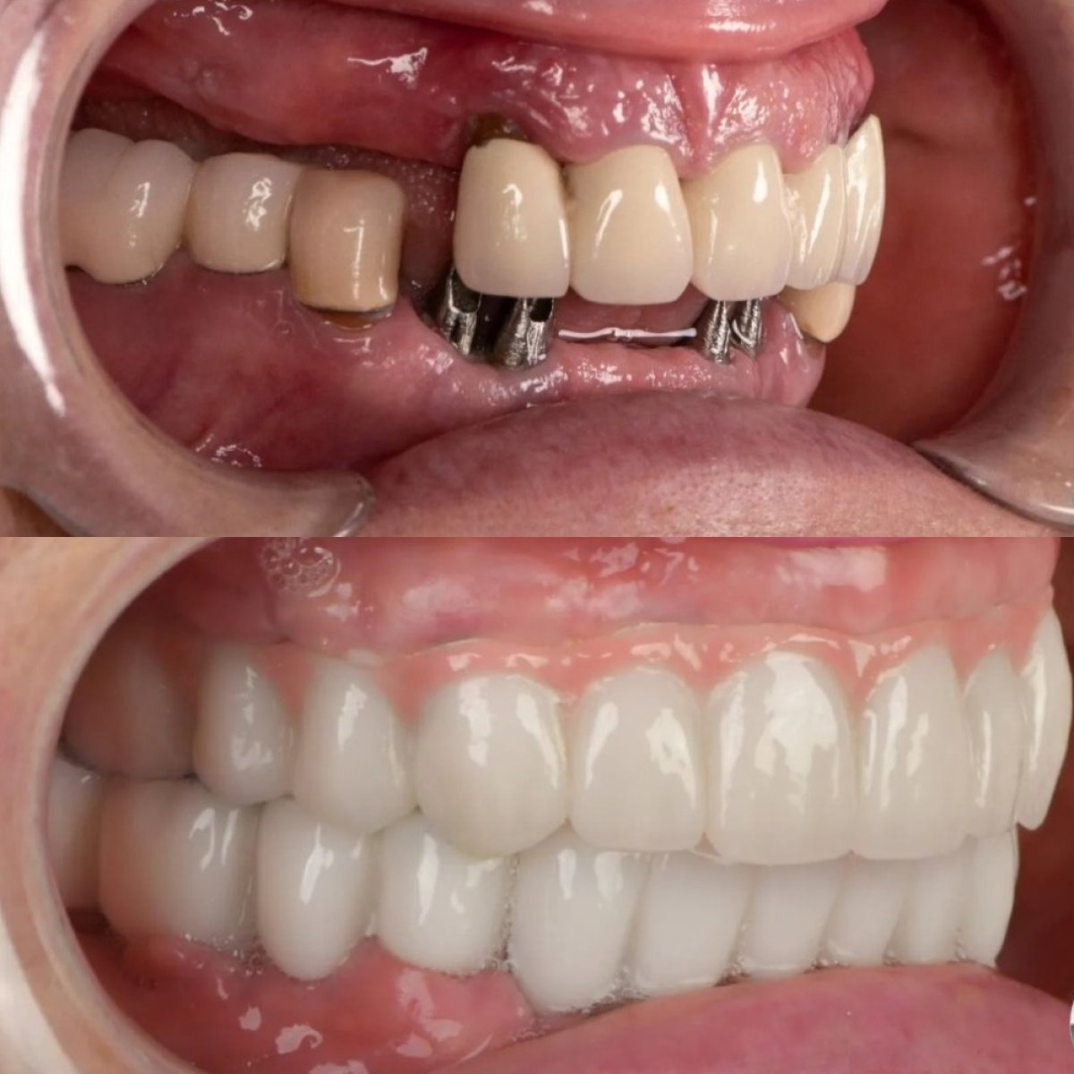 Before and after result of full-arch implant-fixed zirconia dentures at Adalya Dental Clinic