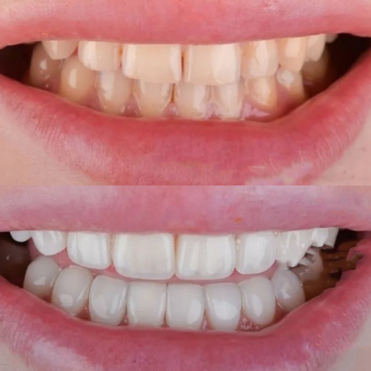 Before and after composite filling results at Adalya Dental Clinic for improved smile aesthetics