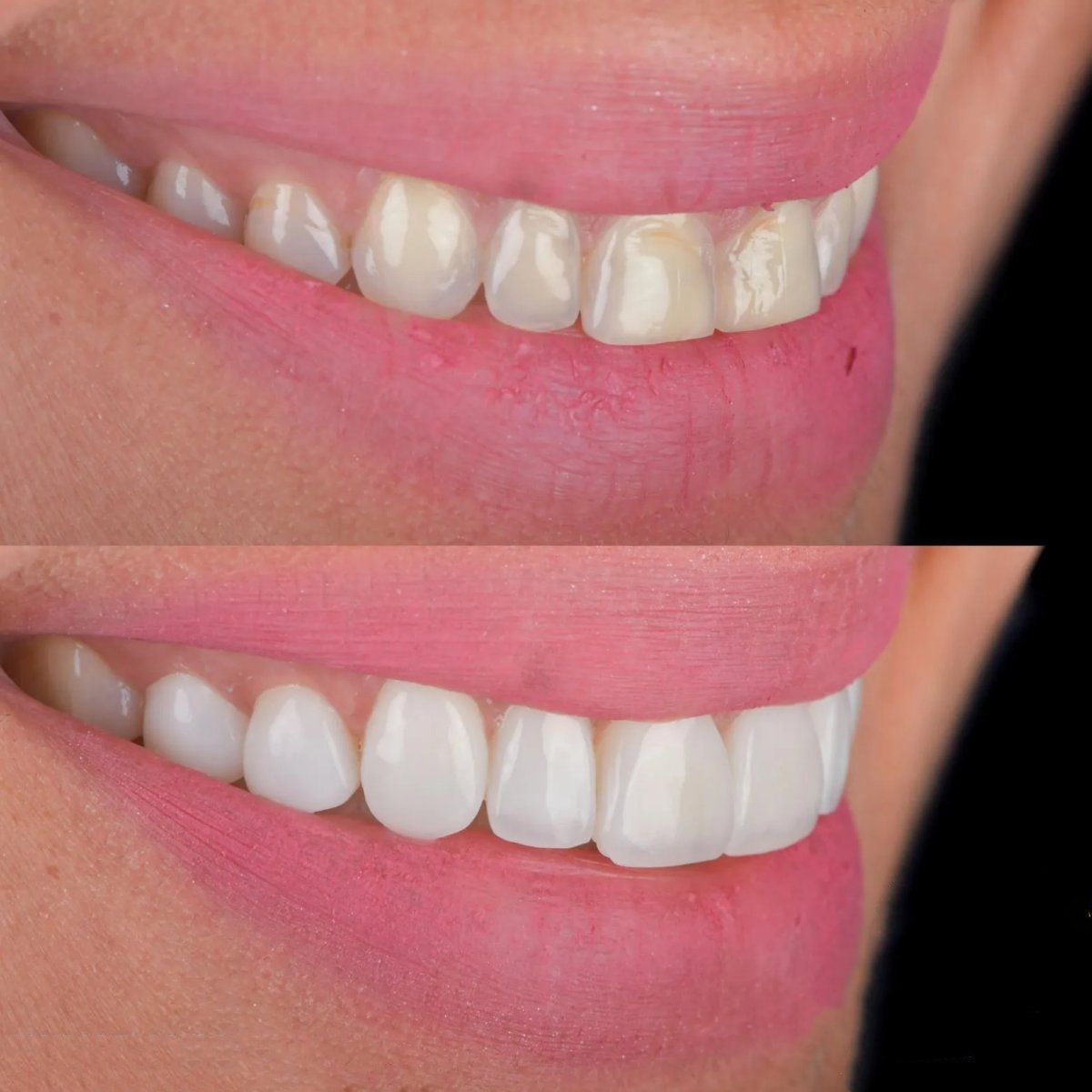 Before and after composite filling results at Adalya Dental Clinic for smile restoration