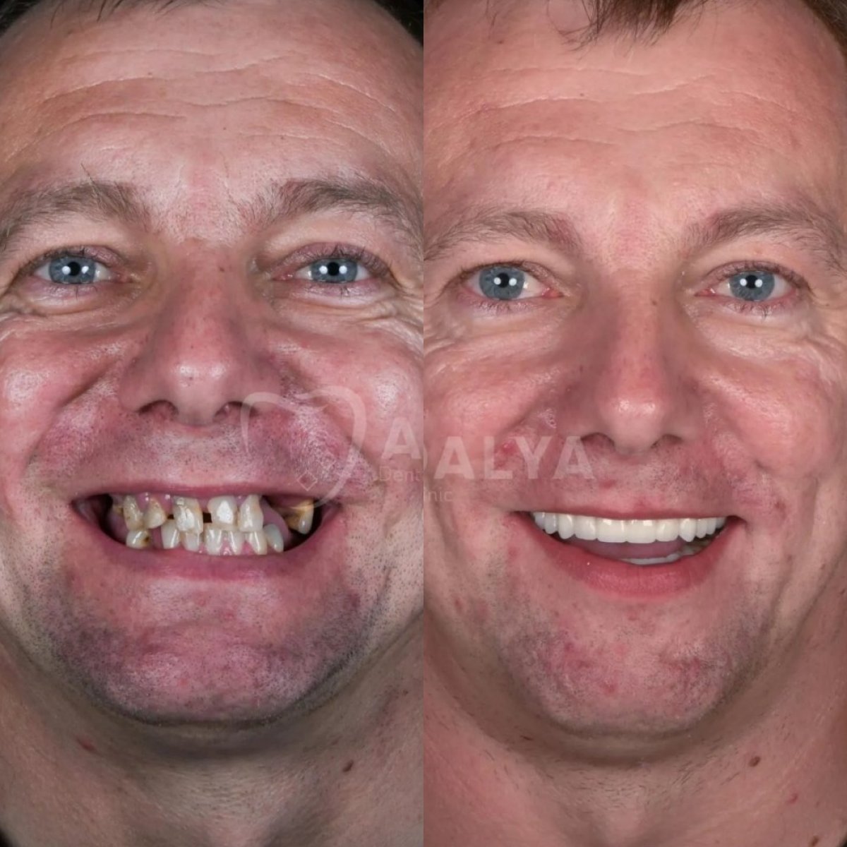 Smile makeover before and after results at Adalya Dental Clinic – restored teeth and bright smile