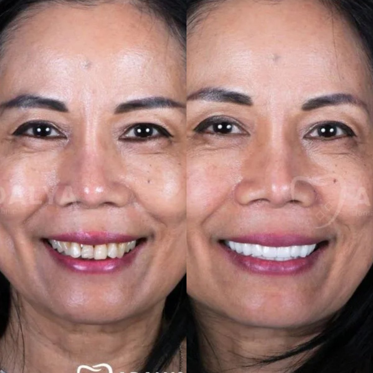Avant et après facettes dentaires à Adalya Dental Clinic – sourire naturel et transformé