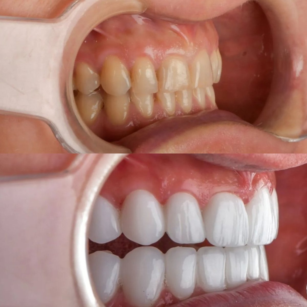 Before and after porcelain veneer results at Adalya Dental Clinic, smile makeover visible