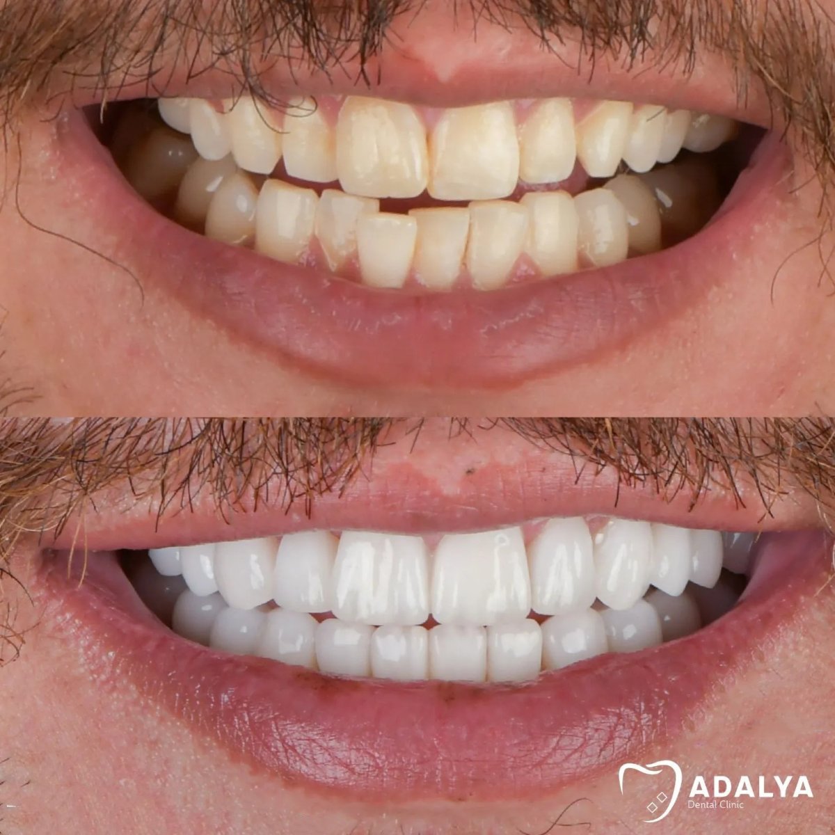 Результаты отбеливания зубов до и после в Adalya Dental Clinic – заметно белее улыбка
