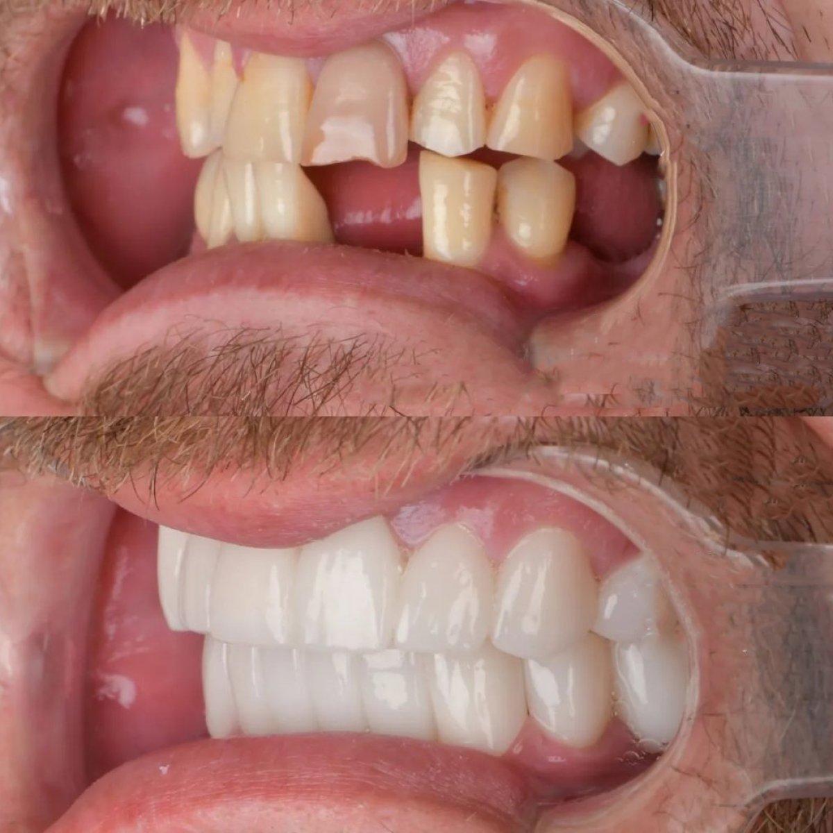 Результат до и после установки имплант-опорного моста в Adalya Dental Clinic