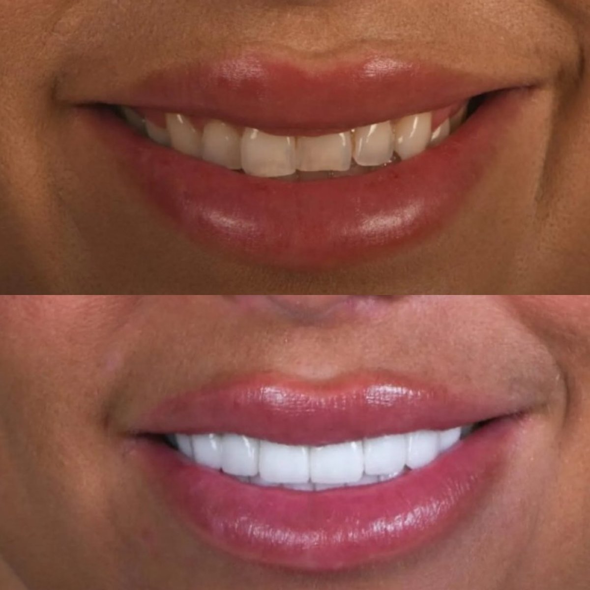 نتائج قبل وبعد تركيب تيجان الزركونيا في Adalya Dental Clinic – تحول الابتسامة