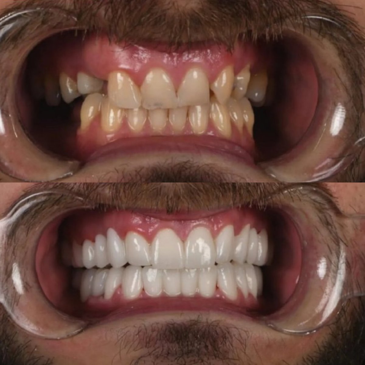 Efekty przed i po założeniu koron cyrkonowych w Adalya Dental Clinic – metamorfoza uśmiechu