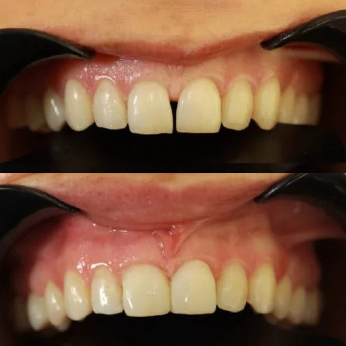 Результаты до и после бондинга зубов в AuraDent Aesthetic Clinic, улучшение улыбки