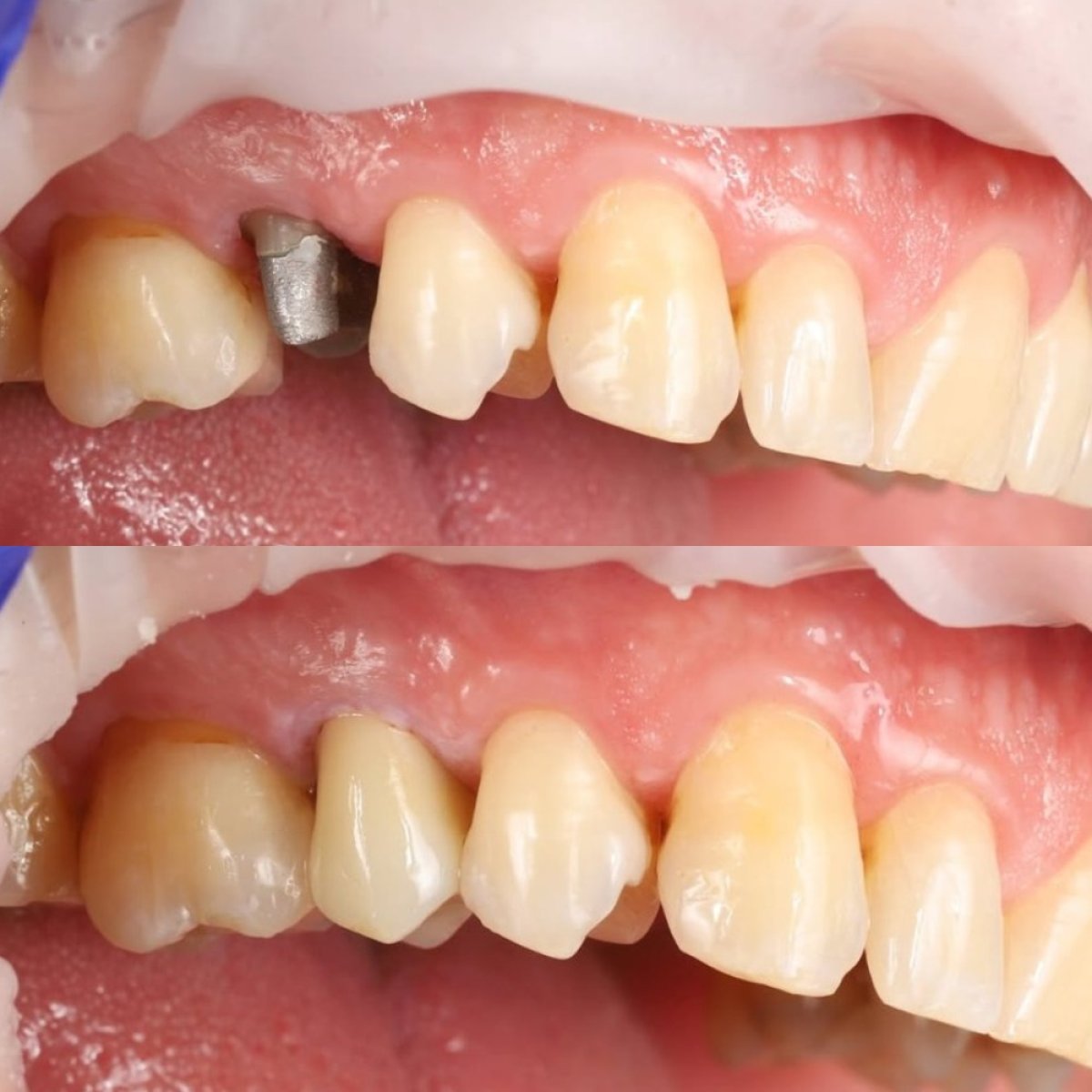 Resultados antes y después de corona metal-cerámica sobre implante en Yourdentist.cz