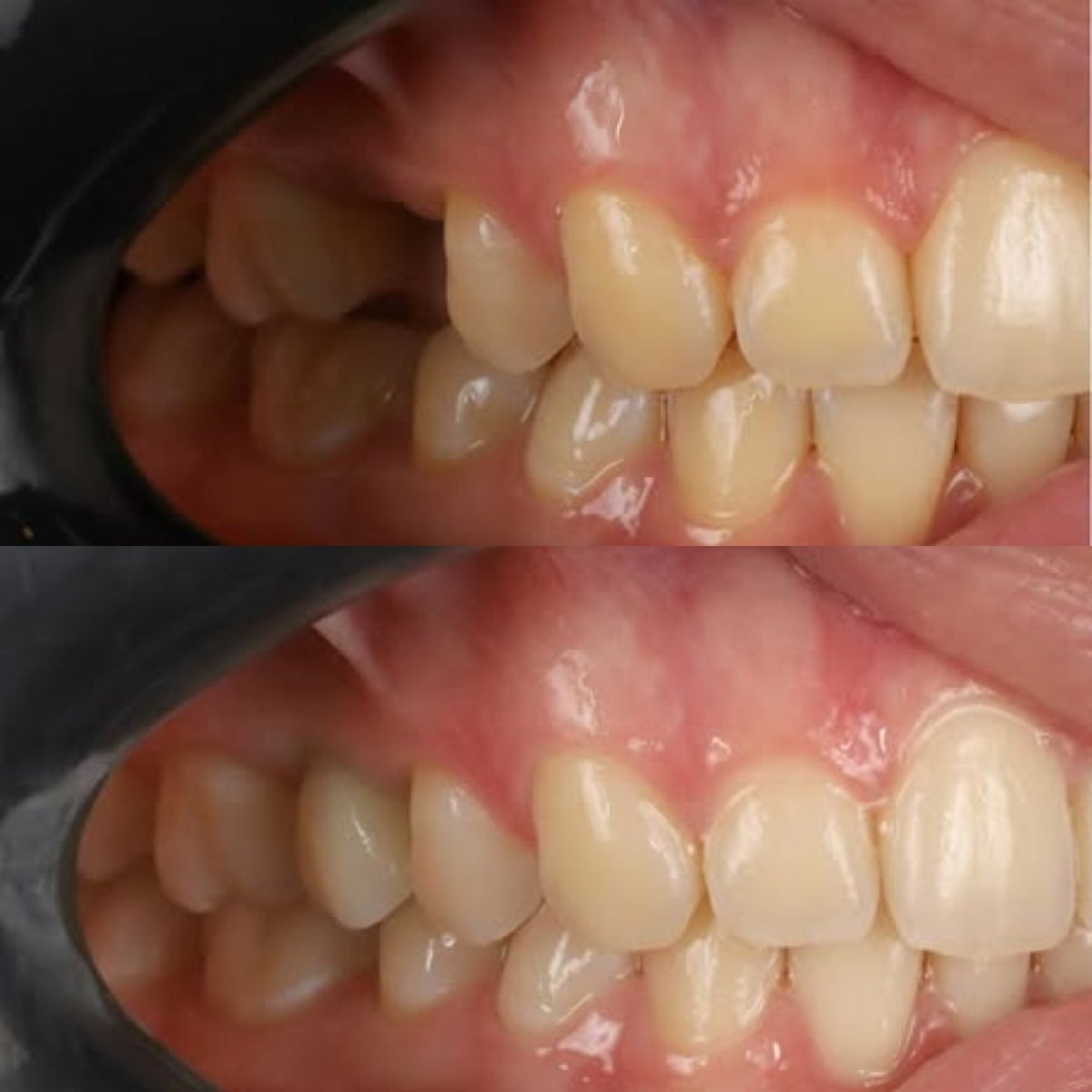 Resultado antes y después de corona metal-cerámica sobre implante en Yourdentist.cz
