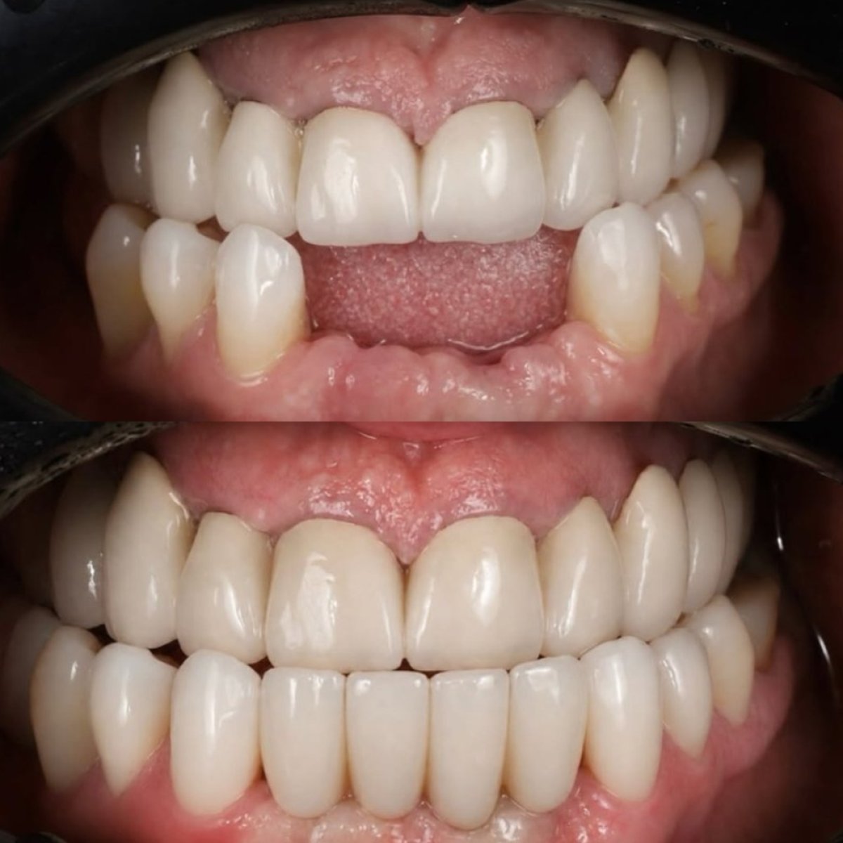 До и после установки фарфоровых коронок в Yourdentist.cz, улучшенный результат улыбки