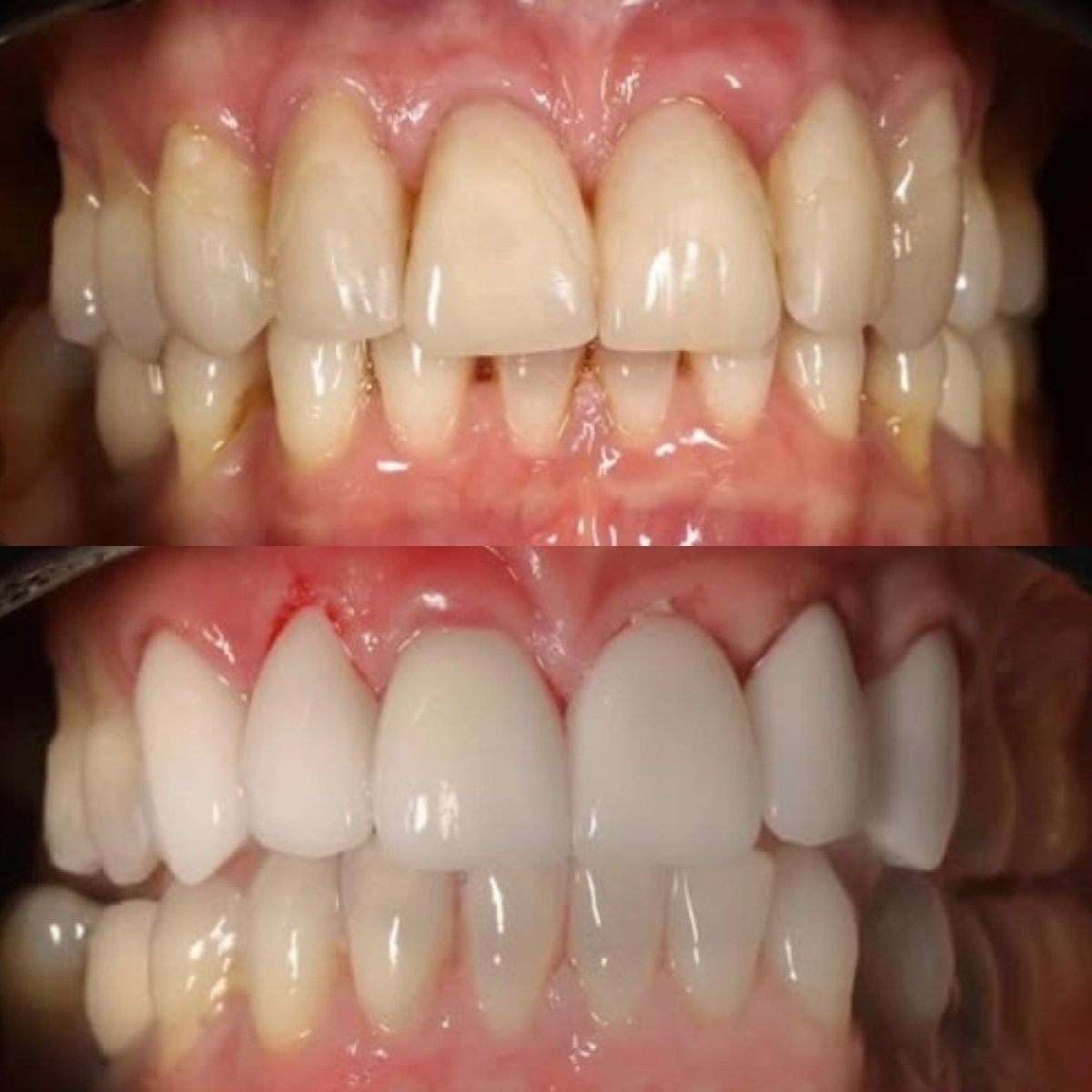 Porcelain veneer before and after results at Yourdentist.cz – brighter, even smile transformation