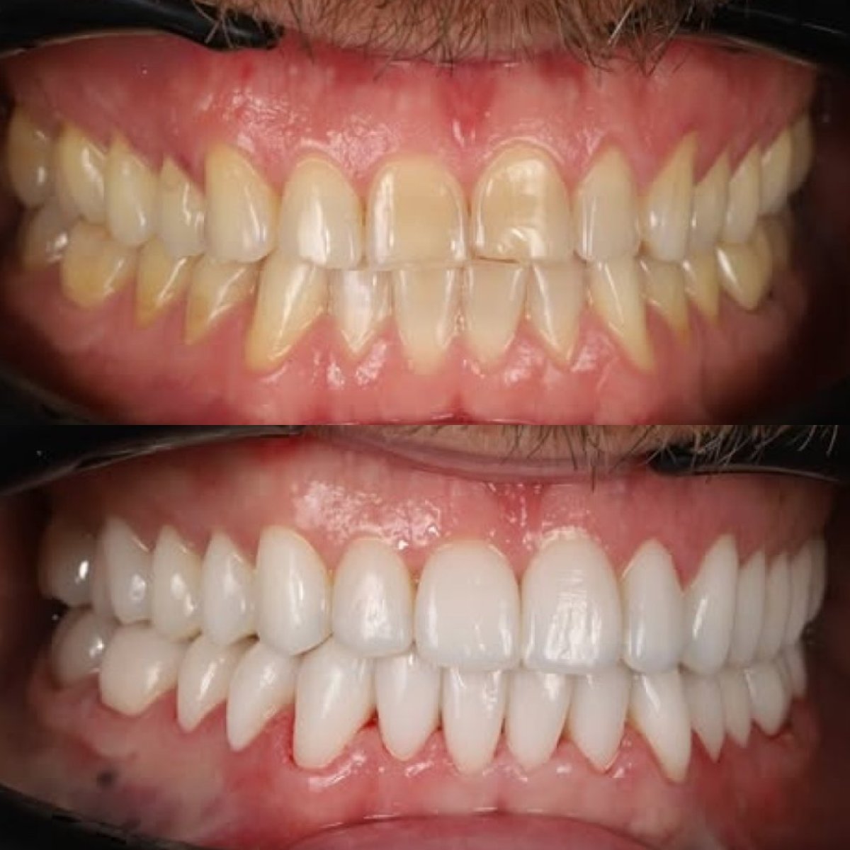 Before and after porcelain veneer results at Yourdentist.cz – whiter, even smile transformation