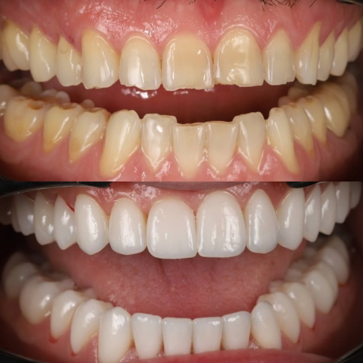 Efekty przed i po licówkach porcelanowych w Yourdentist.cz – bielszy uśmiech