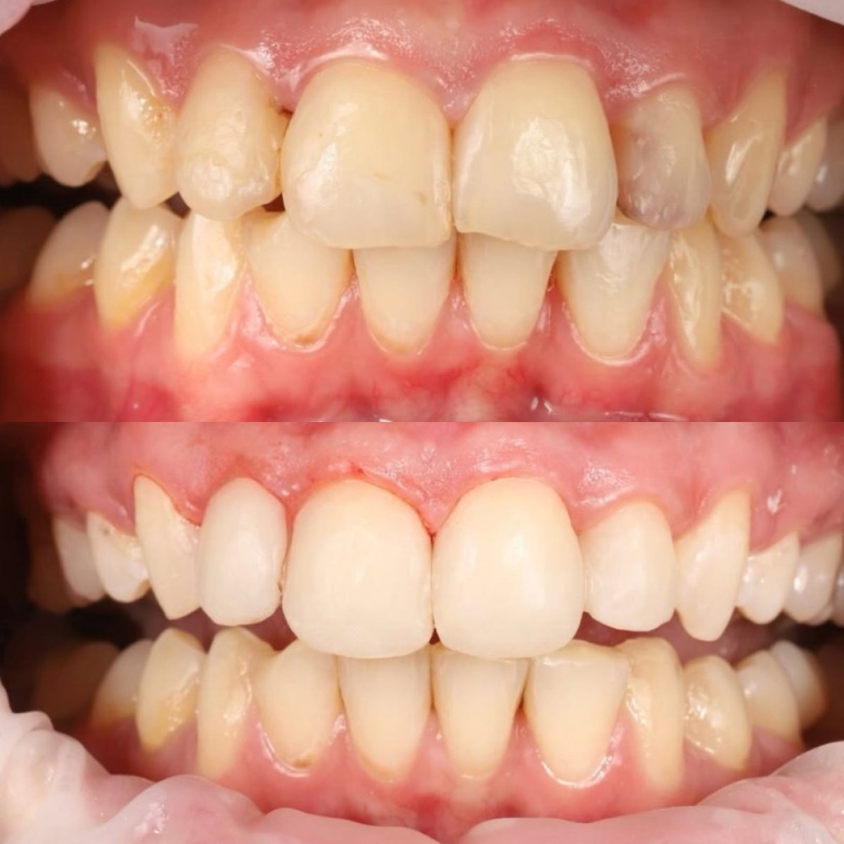 Before and after composite filling results at Yourdentist.cz, improved front teeth appearance