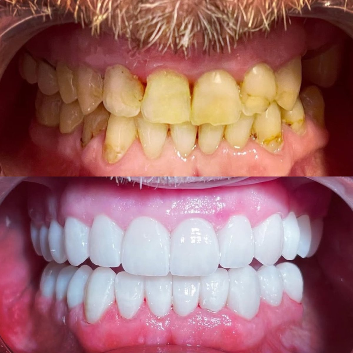 Antes y después de carillas dentales en Hegazy dental clinic – sonrisa transformada y dientes blancos