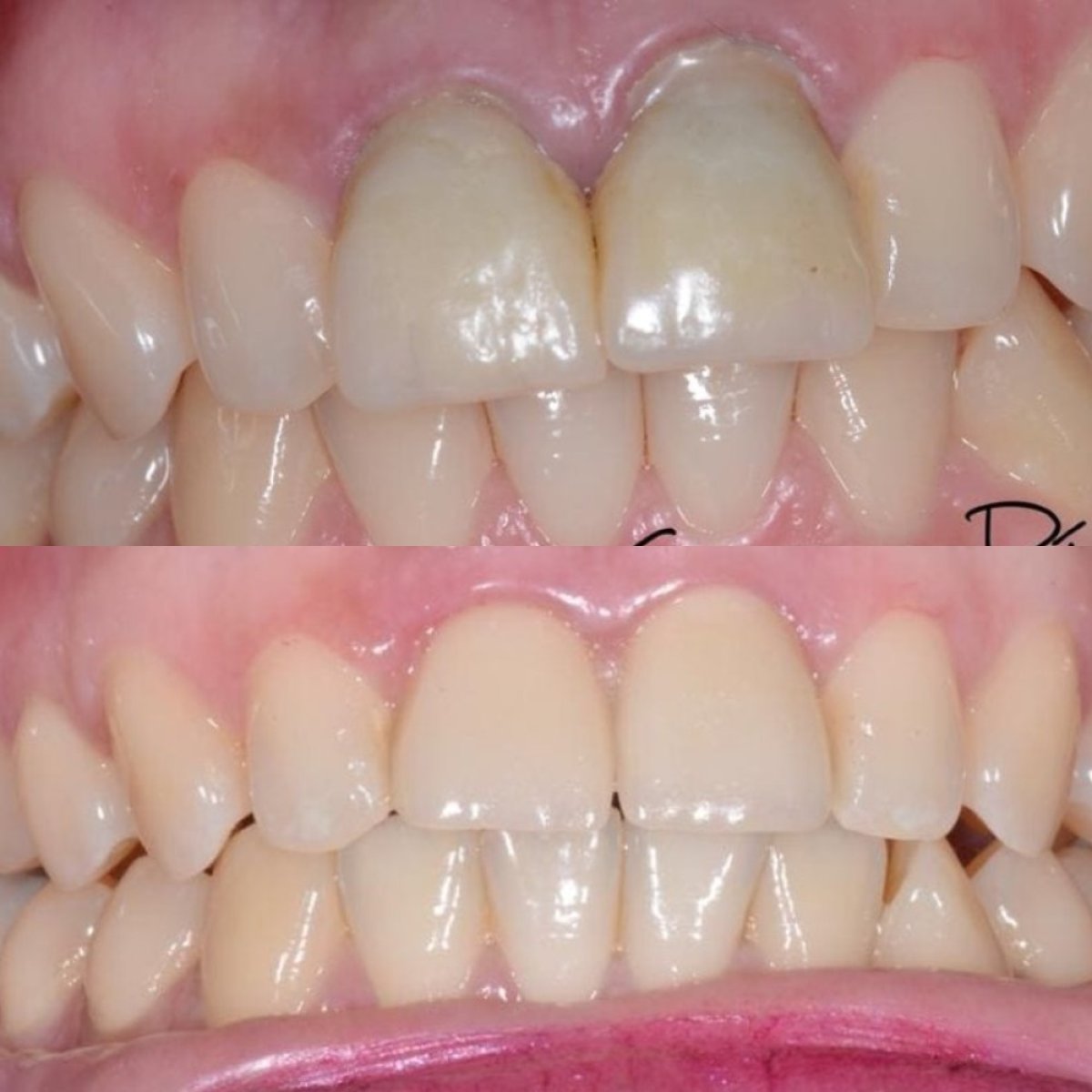 Before and after tooth whitening results at Dr. Junen Gómez clinic, visibly brighter smile