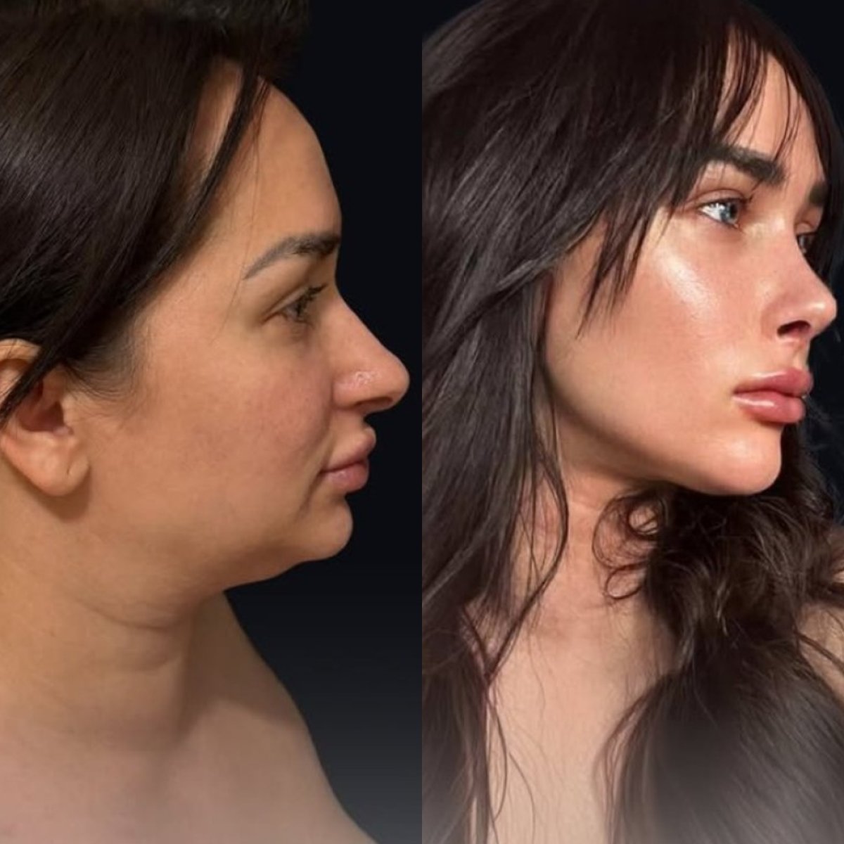 Antes y después de rinoplastia en Dr.Fatih Çınar, resultado de perfil y remodelación nasal