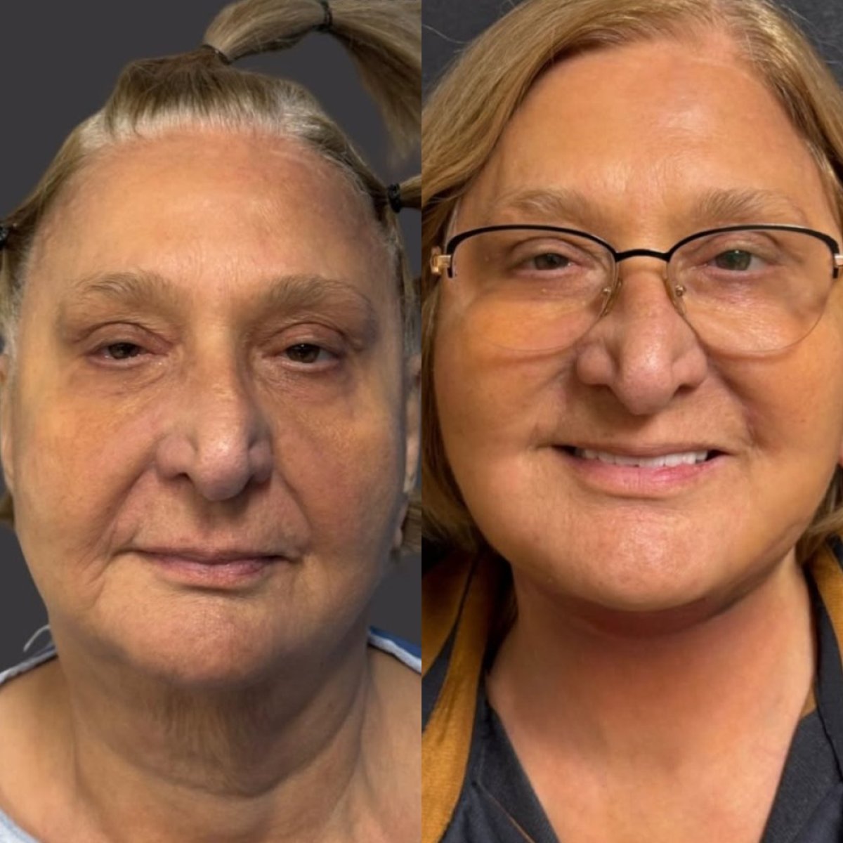 Resultados de lifting de cuello antes y después en Dr.Fatih Çınar, piel visiblemente más firme
