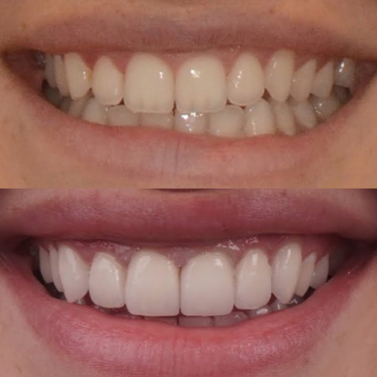 Before and after instant veneers at Gremi Clinic – improved smile aesthetics result