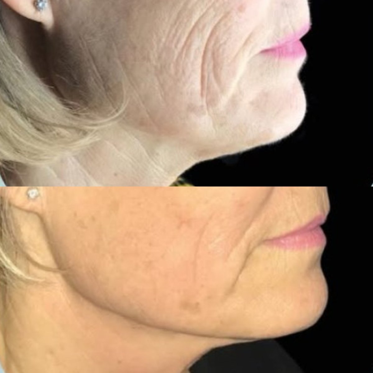 Before and after threads lifting at Avra Institute, visible facial skin tightening result