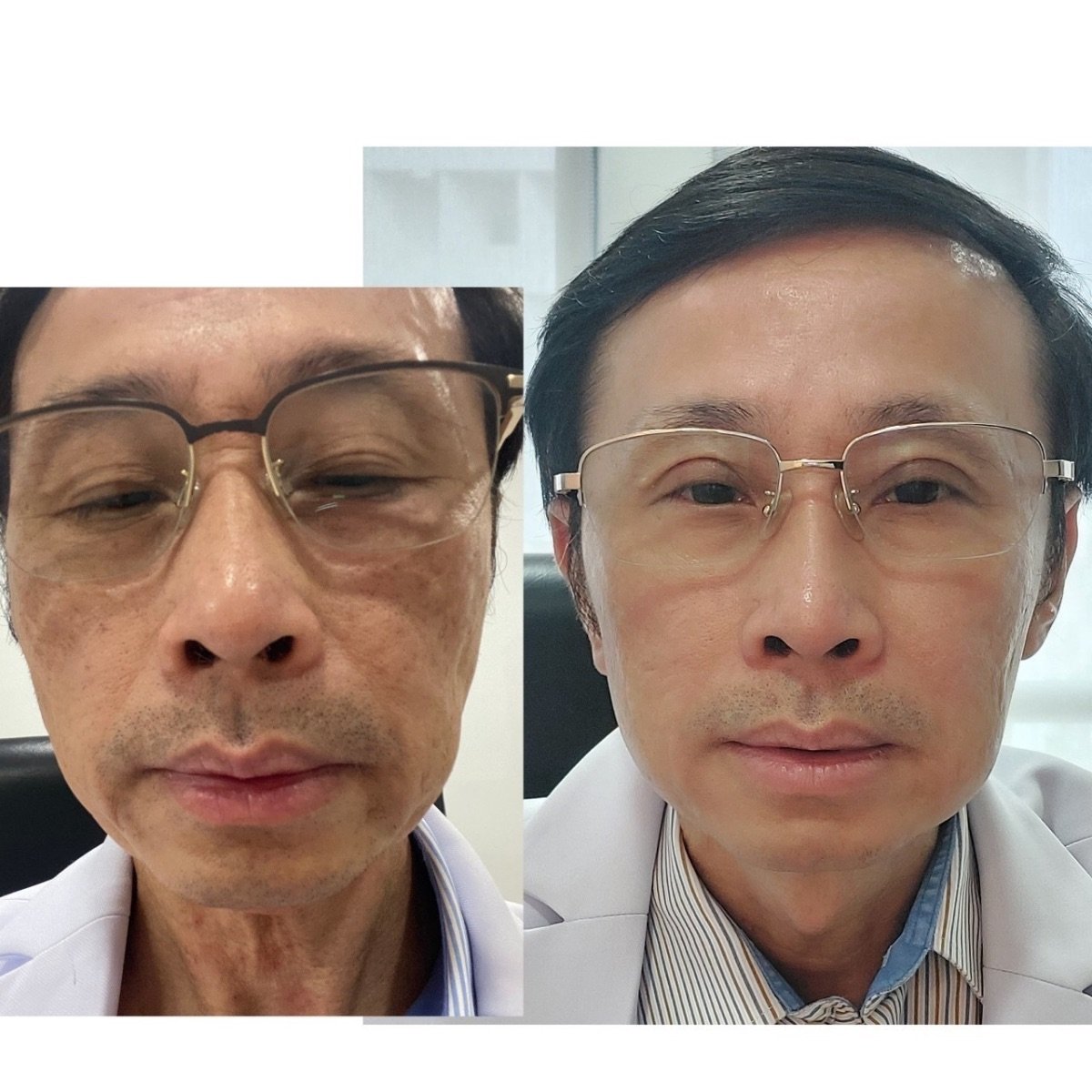 Before and after stem cell rejuvenation therapy results at ID Clinic Bangkok for anti-aging